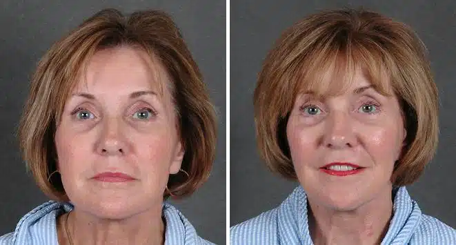 Blepharoplasty Before and After Photos in Omaha, NE, Case 5360