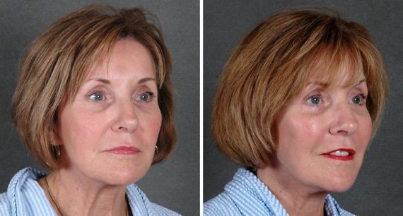 Blepharoplasty Before and After Photos in Omaha, NE, Case 5360