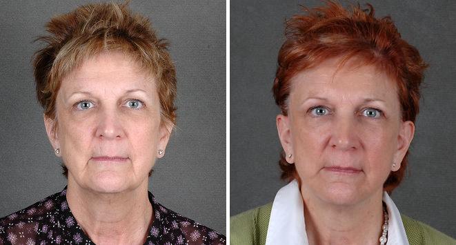 Blepharoplasty Before and After Photos in Omaha, NE, Case 5368