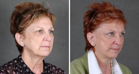 Blepharoplasty Before and After Photos in Omaha, NE, Case 5368