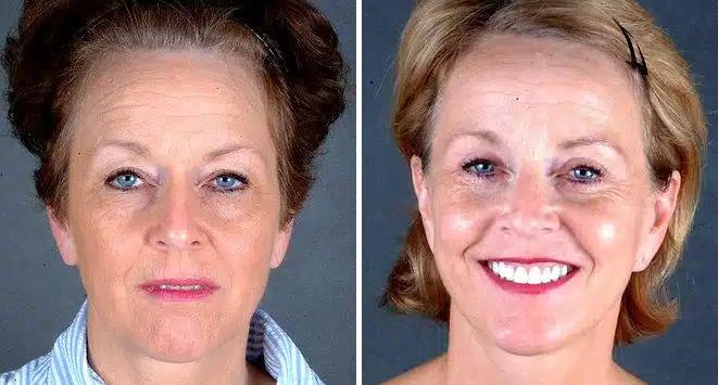 Blepharoplasty Before and After Photos in Omaha, NE, Case 5389