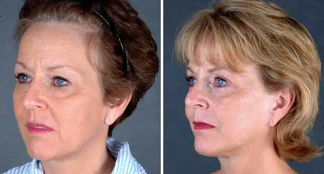 Blepharoplasty Before and After Photos in Omaha, NE, Case 5389