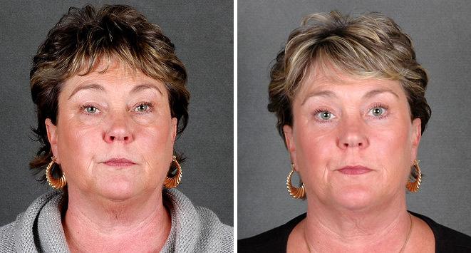 Blepharoplasty Before and After Photos in Omaha, NE, Case 5403