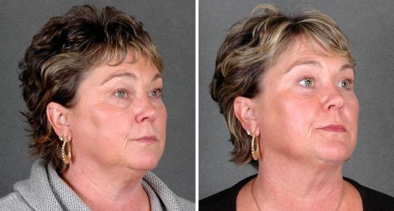 Blepharoplasty Before and After Photos in Omaha, NE, Case 5403