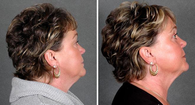 Blepharoplasty Before and After Photos in Omaha, NE, Case 5403