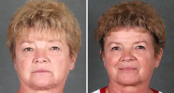 Blepharoplasty Before and After Photos in Omaha, NE, Case 5271