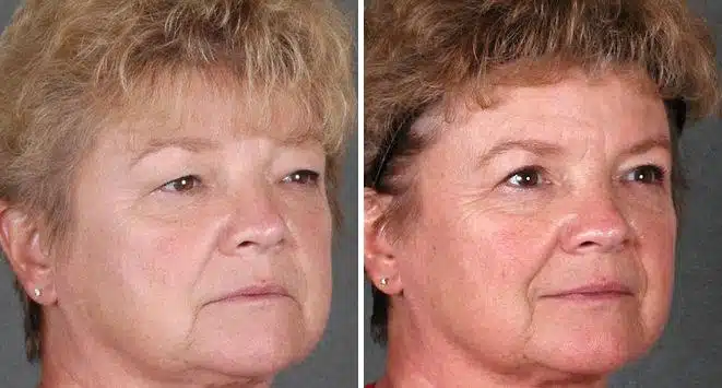 Blepharoplasty Before and After Photos in Omaha, NE, Case 5271