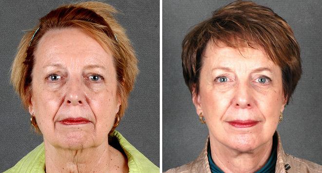 Blepharoplasty Before and After Photos in Omaha, NE, Case 5290