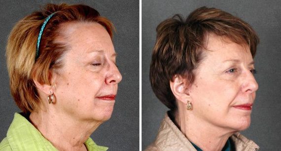 Blepharoplasty Before and After Photos in Omaha, NE, Case 5290