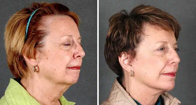 Blepharoplasty Before and After Photos in Omaha, NE, Case 5290