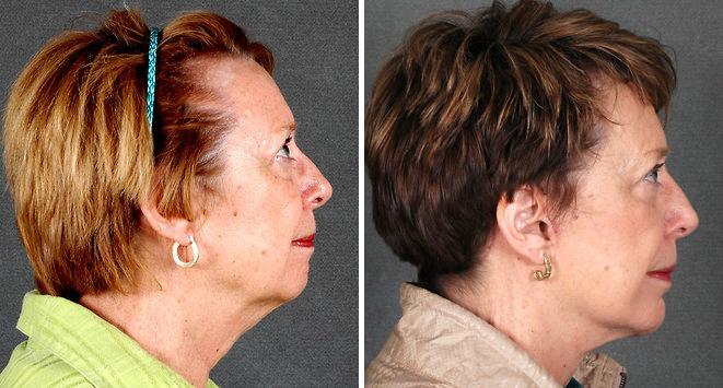 Case 5290, Blepharoplasty Before and After Photos Blepharoplasty Before and After Photos in Omaha, NE, Case 5290