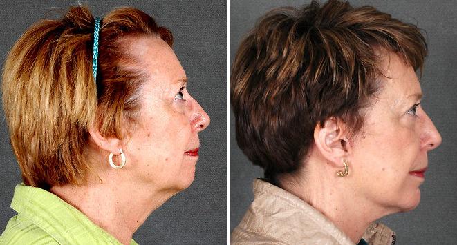 Blepharoplasty Before and After Photos in Omaha, NE, Case 5290