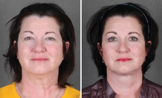 Blepharoplasty Before and After Photos in Omaha, NE, Case 5317