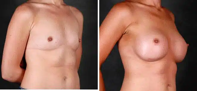 Breast Augmentation Before and After Photos in Omaha, NE, Case 5277