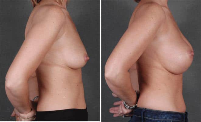 Breast Augmentation Before and After Photos in Omaha, NE, Case 5316