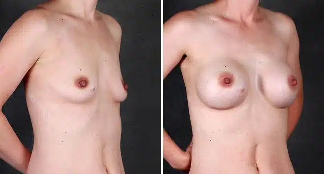 Breast Augmentation Before and After Photos in Omaha, NE, Case 5339