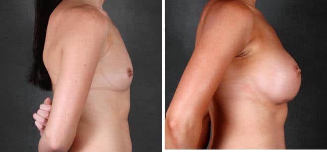 Breast Augmentation Before and After Photos in Omaha, NE, Case 5277