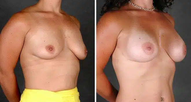 Breast Augmentation Before and After Photos in Omaha, NE, Case 5367