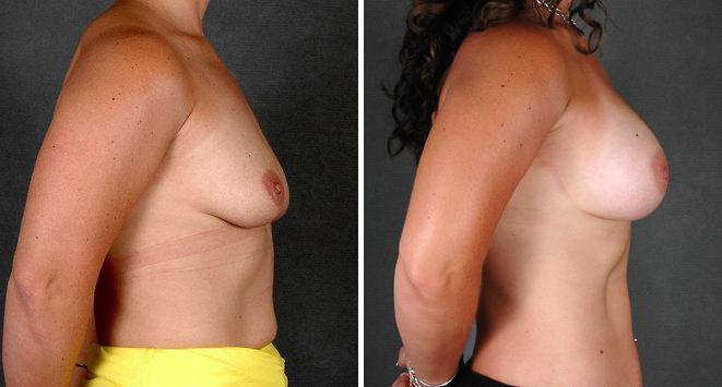 Breast Augmentation Before and After Photos in Omaha, NE, Case 5367