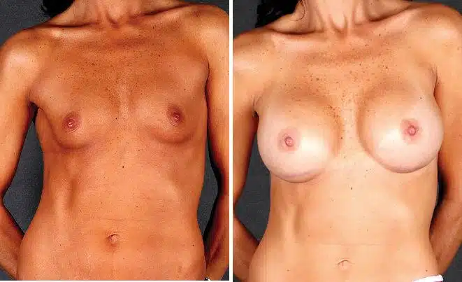 Breast Augmentation Before and After Photos in Omaha, NE, Case 5381