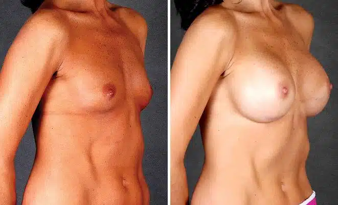 Breast Augmentation Before and After Photos in Omaha, NE, Case 5381