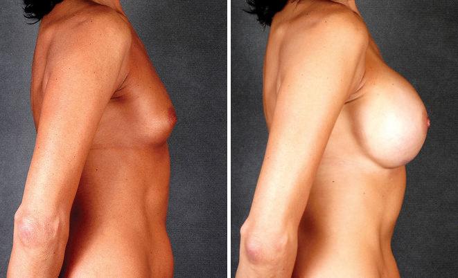 Breast Augmentation Before and After Photos in Omaha, NE, Case 5381