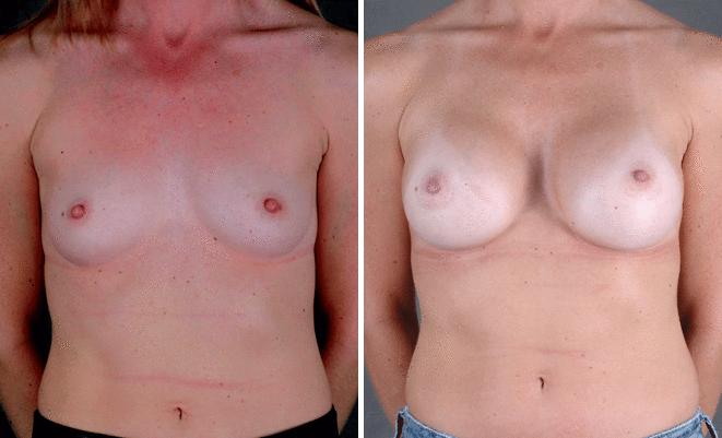 Breast Augmentation Before and After Photos in Omaha, NE, Case 5390