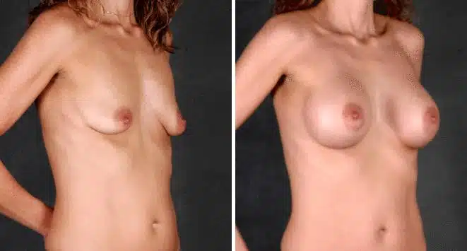 Breast Augmentation Before and After Photos in Omaha, NE, Case 5291