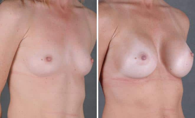 Breast Augmentation Before and After Photos in Omaha, NE, Case 5390