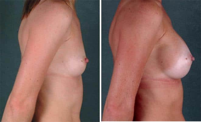 Breast Augmentation Before and After Photos in Omaha, NE, Case 5390