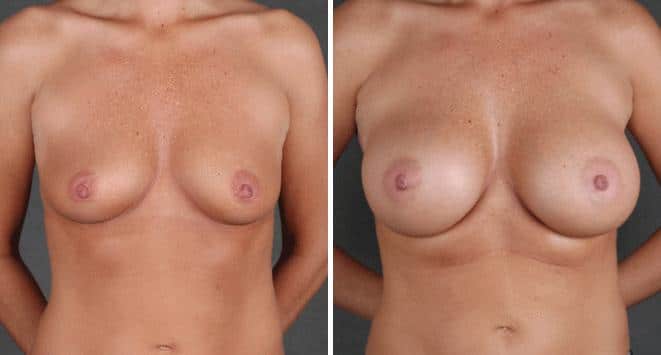 Case 5404, Breast Augmentation Before and After Photos Breast Augmentation Before and After Photos in Omaha, NE, Case 5404