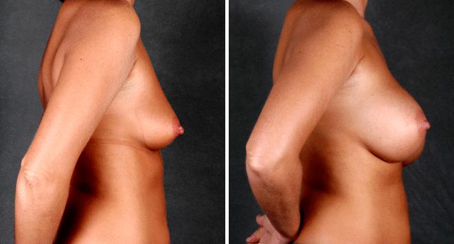 Case 5404, Breast Augmentation Before and After Photos Breast Augmentation Before and After Photos in Omaha, NE, Case 5404