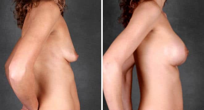 Breast Augmentation Before and After Photos in Omaha, NE, Case 5291