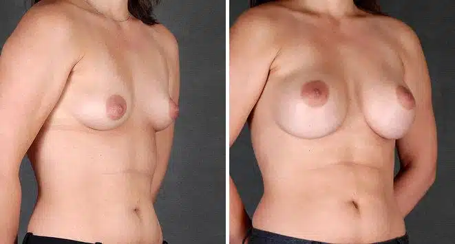 Breast Augmentation Before and After Photos in Omaha, NE, Case 5415