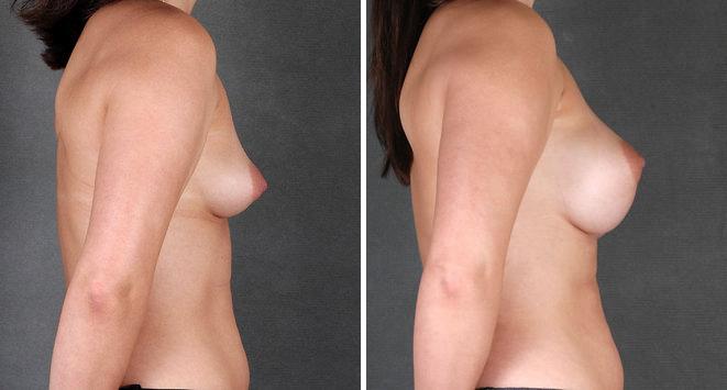 Breast Augmentation Before and After Photos in Omaha, NE, Case 5415