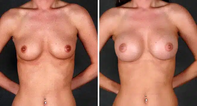 Breast Augmentation Before and After Photos in Omaha, NE, Case 5304