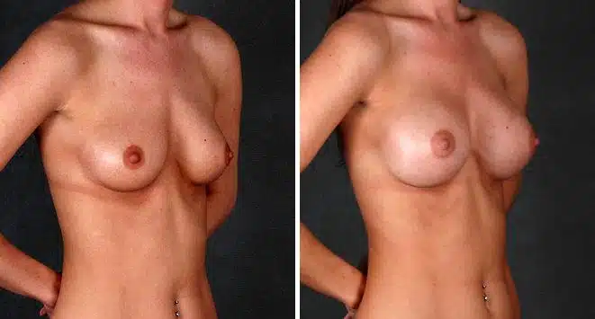 Breast Augmentation Before and After Photos in Omaha, NE, Case 5304