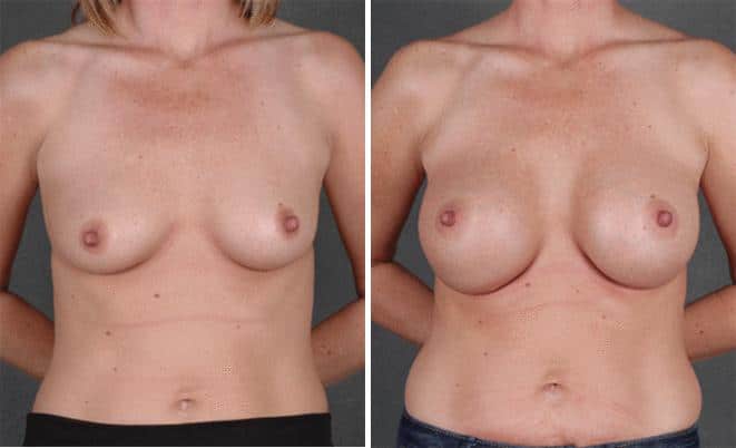Breast Augmentation Before and After Photos in Omaha, NE, Case 5316
