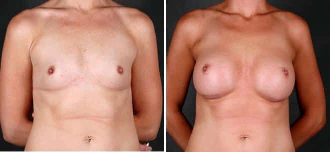 Breast Augmentation Before and After Photos in Omaha, NE, Case 5277