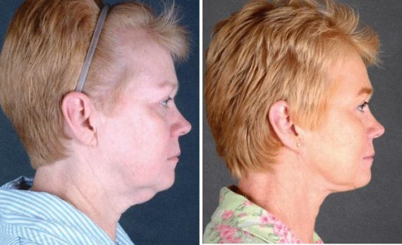 Blepharoplasty Before and After Photos in Omaha, NE, Case 5416