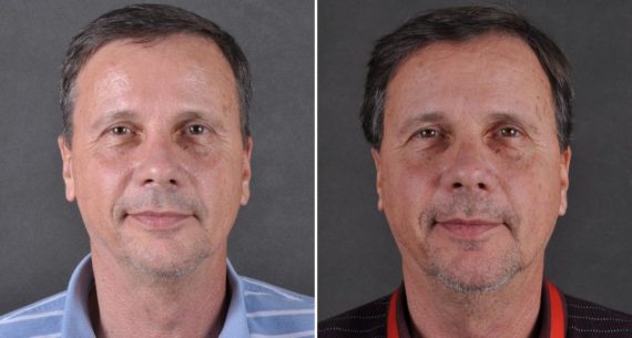 Blepharoplasty Before and After Photos in Omaha, NE, Case 8806