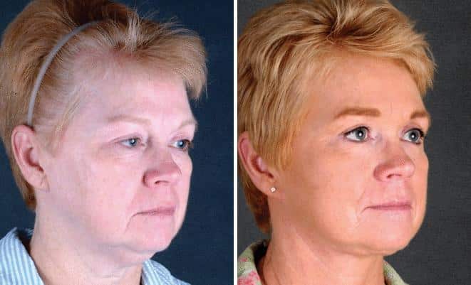 Blepharoplasty Before and After Photos in Omaha, NE, Case 5416