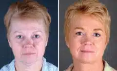 Blepharoplasty Before and After Photos in Omaha, NE, Case 5416