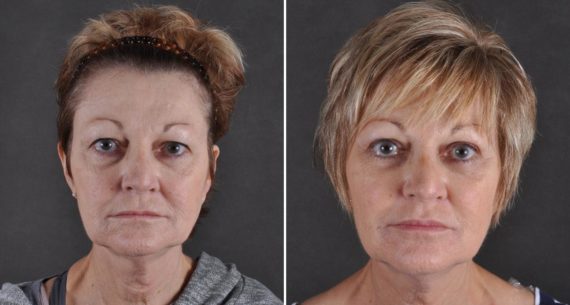 Blepharoplasty Before and After Photos in Omaha, NE, Case 9457