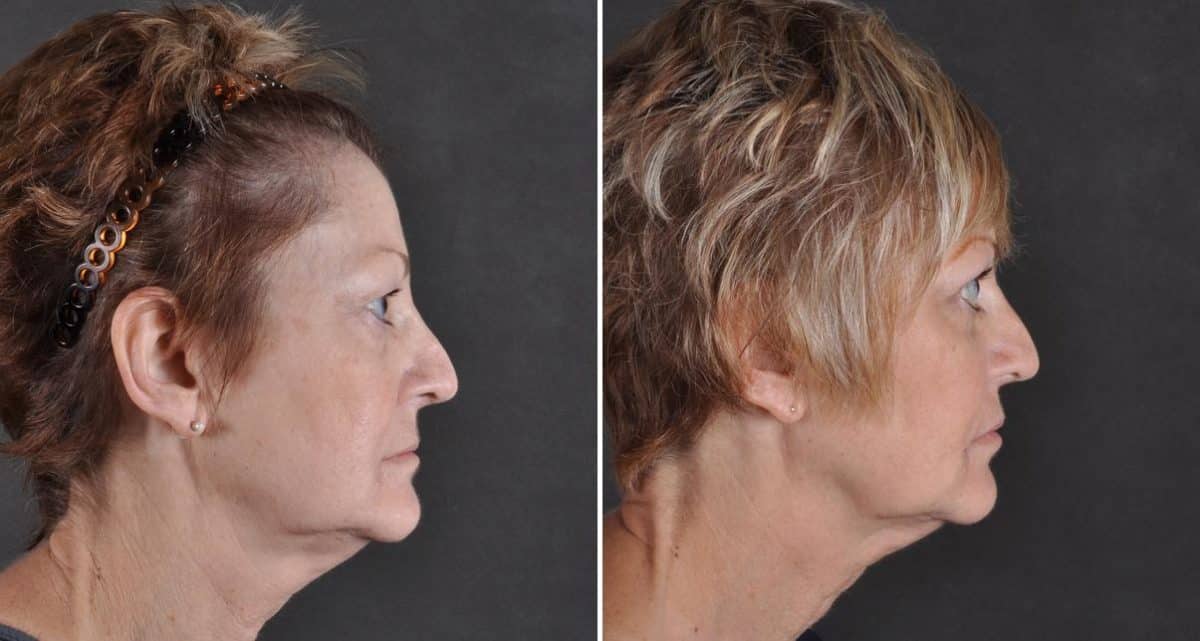 Blepharoplasty Before and After Photos in Omaha, NE, Case 9457