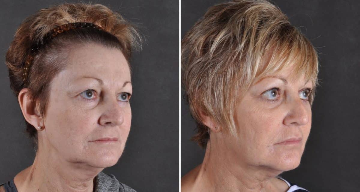 Blepharoplasty Before and After Photos in Omaha, NE, Case 9457