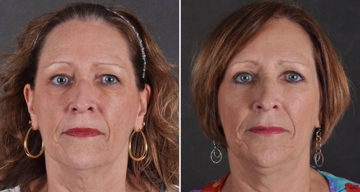 Blepharoplasty Before and After Photos in Omaha, NE, Case 9712