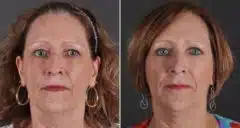 Blepharoplasty Before and After Photos in Omaha, NE, Case 9712