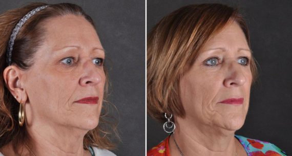 Blepharoplasty Before and After Photos in Omaha, NE, Case 9712