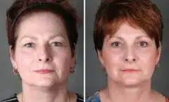 Blepharoplasty Before and After Photos in Omaha, NE, Case 5437